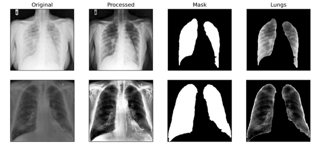 Figure 4 for Classification of COVID-19 on chest X-Ray images using Deep Learning model with Histogram Equalization and Lungs Segmentation