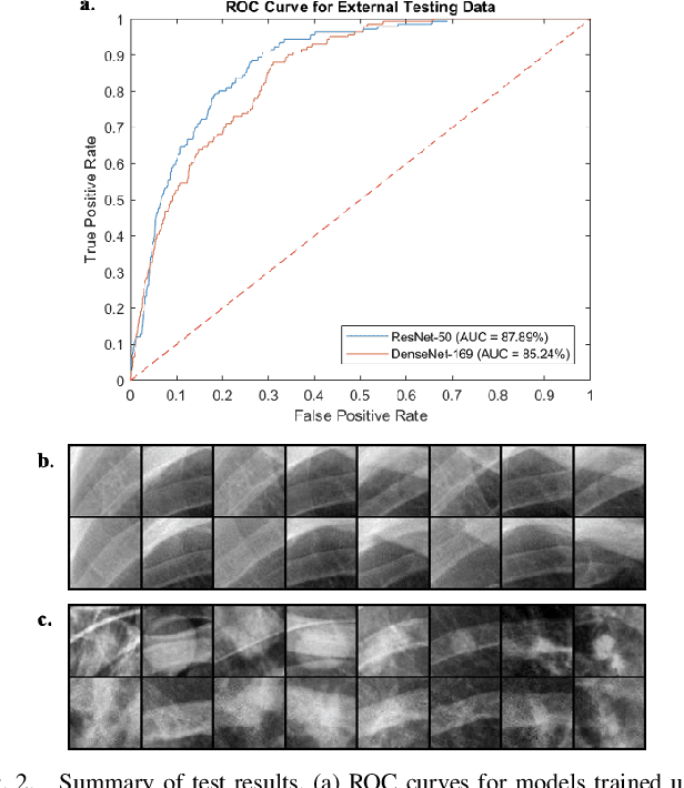 Figure 2 for Unsupervised Detection of Lung Nodules in Chest Radiography Using Generative Adversarial Networks
