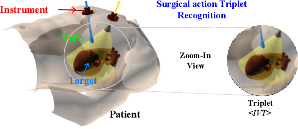 Figure 1 for Why Deep Surgical Models Fail?: Revisiting Surgical Action Triplet Recognition through the Lens of Robustness