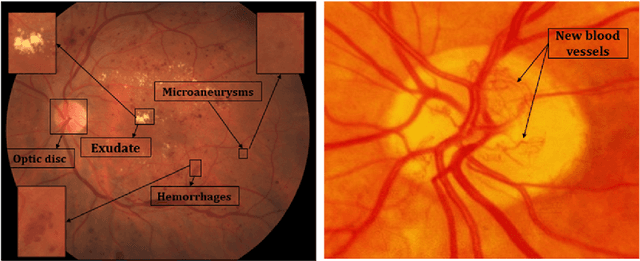 Figure 1 for Deep Learning based Computer-Aided Diagnosis Systems for Diabetic Retinopathy: A Survey