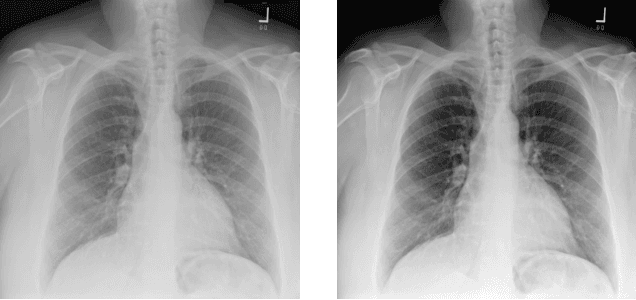 Figure 4 for Multi-task Learning for Chest X-ray Abnormality Classification on Noisy Labels