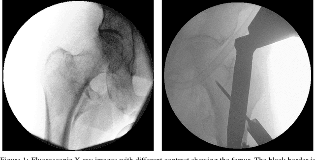 Figure 1 for Deep Morphing: Detecting bone structures in fluoroscopic X-ray images with prior knowledge