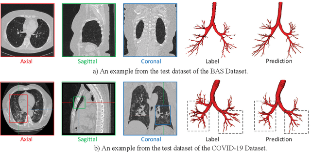 Figure 1 for FDA: Feature Decomposition and Aggregation for Robust Airway Segmentation