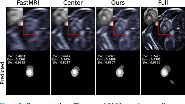 Figure 2 for Optimal MRI Undersampling Patterns for Ultimate Benefit of Medical Vision Tasks