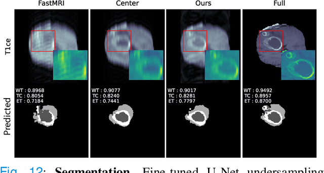 Figure 4 for Optimal MRI Undersampling Patterns for Ultimate Benefit of Medical Vision Tasks