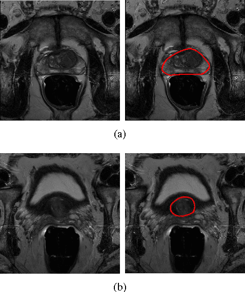 Figure 4 for Deeply-Supervised CNN for Prostate Segmentation