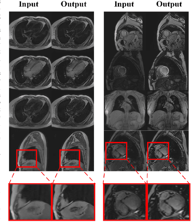 Figure 1 for CMR motion artifact correction using generative adversarial nets