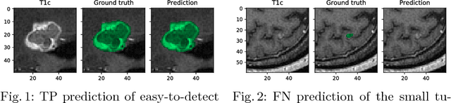 Figure 2 for Tumor Delineation For Brain Radiosurgery by a ConvNet and Non-Uniform Patch Generation