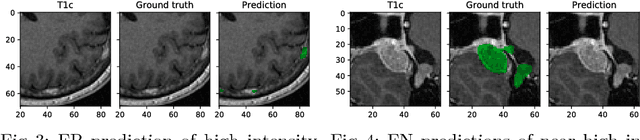 Figure 4 for Tumor Delineation For Brain Radiosurgery by a ConvNet and Non-Uniform Patch Generation