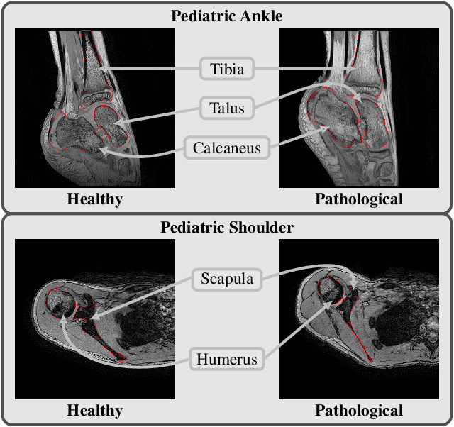 Figure 1 for Multi-structure bone segmentation in pediatric MR images with combined regularization from shape priors and adversarial network