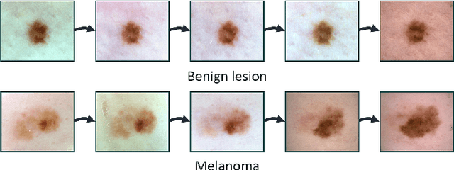 Figure 1 for Early Melanoma Diagnosis with Sequential Dermoscopic Images