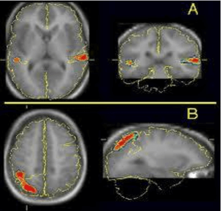 Figure 1 for Automatic symmetry based cluster approach for anomalous brain identification in PET scan image : An Analysis
