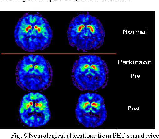 Figure 2 for Automatic symmetry based cluster approach for anomalous brain identification in PET scan image : An Analysis