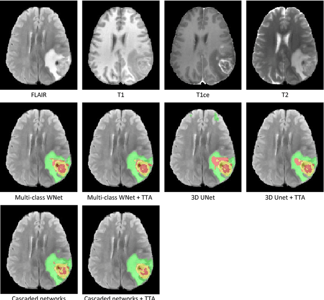 Figure 1 for Automatic Brain Tumor Segmentation using Convolutional Neural Networks with Test-Time Augmentation