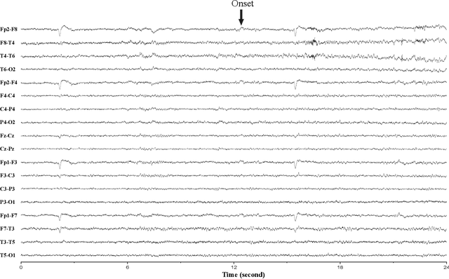 Figure 2 for Prospective Identification of Ictal Electroencephalogram