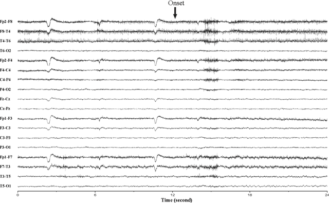 Figure 3 for Prospective Identification of Ictal Electroencephalogram