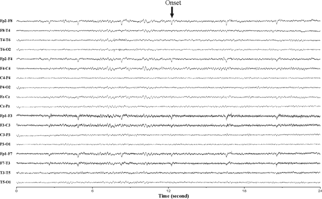 Figure 4 for Prospective Identification of Ictal Electroencephalogram