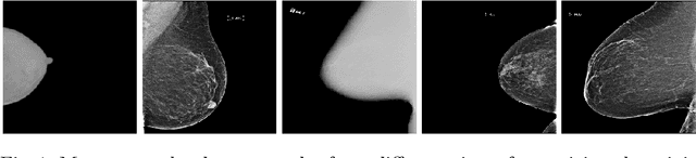 Figure 1 for Federated Learning for Breast Density Classification: A Real-World Implementation