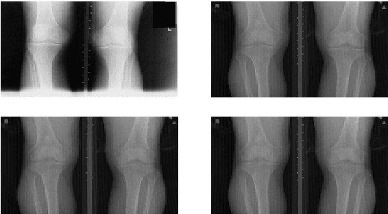 Figure 1 for Quantifying Radiographic Knee Osteoarthritis Severity using Deep Convolutional Neural Networks