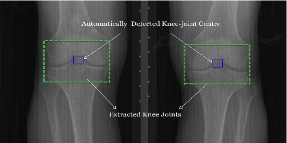 Figure 3 for Quantifying Radiographic Knee Osteoarthritis Severity using Deep Convolutional Neural Networks