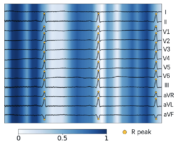 Figure 1 for Identifying Electrocardiogram Abnormalities Using a Handcrafted-Rule-Enhanced Neural Network