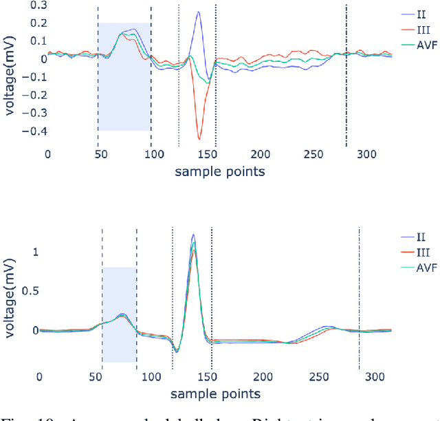Figure 2 for Identifying Electrocardiogram Abnormalities Using a Handcrafted-Rule-Enhanced Neural Network