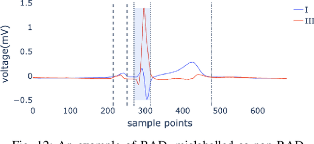 Figure 4 for Identifying Electrocardiogram Abnormalities Using a Handcrafted-Rule-Enhanced Neural Network