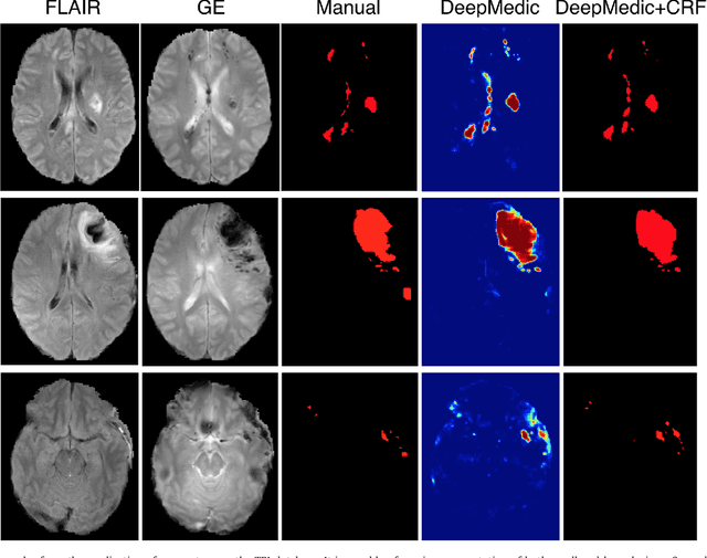Figure 4 for Efficient Multi-Scale 3D CNN with Fully Connected CRF for Accurate Brain Lesion Segmentation