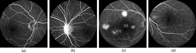 Figure 1 for Generating Fundus Fluorescence Angiography Images from Structure Fundus Images Using Generative Adversarial Networks