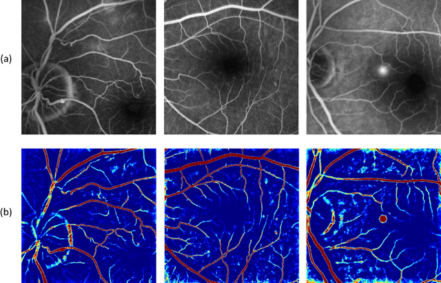 Figure 3 for Generating Fundus Fluorescence Angiography Images from Structure Fundus Images Using Generative Adversarial Networks