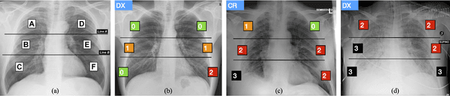 Figure 1 for End-to-end learning for semiquantitative rating of COVID-19 severity on Chest X-rays