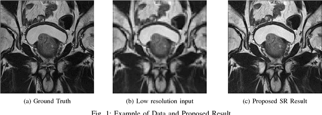 Figure 1 for An Application of Generative Adversarial Networks for Super Resolution Medical Imaging