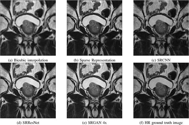 Figure 4 for An Application of Generative Adversarial Networks for Super Resolution Medical Imaging