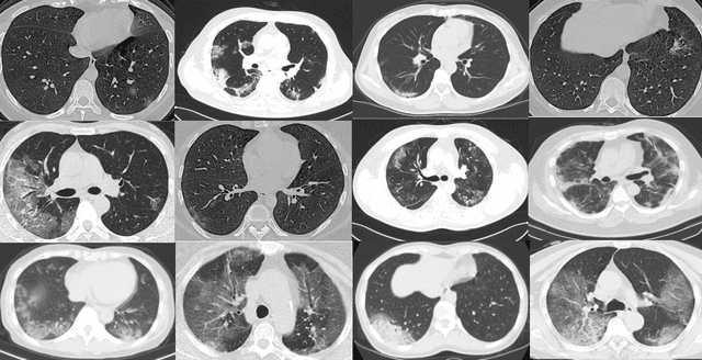 Figure 3 for COVID-CT-Dataset: A CT Scan Dataset about COVID-19