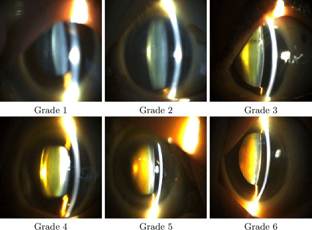 Figure 1 for Tournament Based Ranking CNN for the Cataract grading