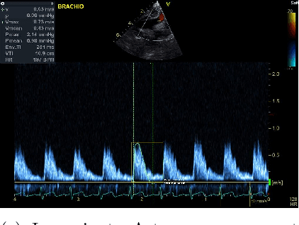 Figure 2 for Machine Learning based Extraction of Boundary Conditions from Doppler Echo Images for Patient Specific Coarctation of the Aorta: Computational Fluid Dynamics Study