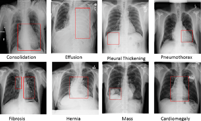 Figure 1 for An Incremental Learning Approach to Automatically Recognize Pulmonary Diseases from the Multi-vendor Chest Radiographs