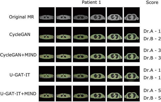 Figure 2 for Unsupervised-learning-based method for chest MRI-CT transformation using structure constrained unsupervised generative attention networks