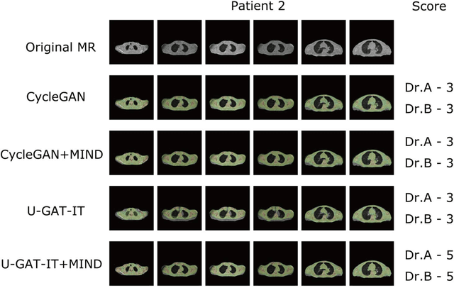 Figure 3 for Unsupervised-learning-based method for chest MRI-CT transformation using structure constrained unsupervised generative attention networks