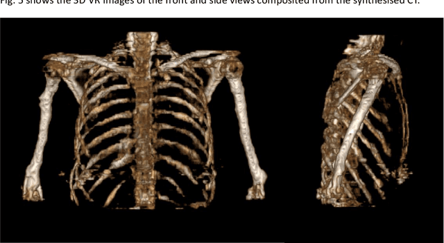 Figure 4 for Unsupervised-learning-based method for chest MRI-CT transformation using structure constrained unsupervised generative attention networks
