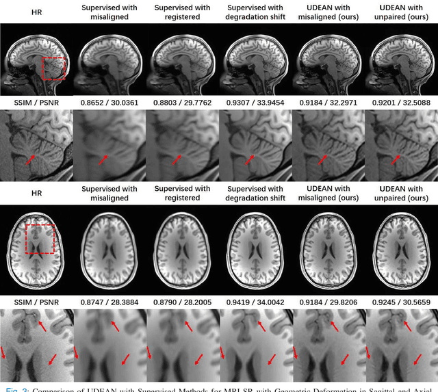 Figure 3 for Unsupervised Representation Learning for 3D MRI Super Resolution with Degradation Adaptation