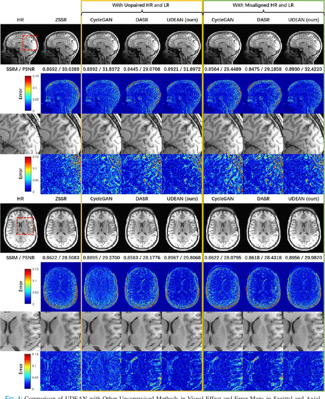 Figure 4 for Unsupervised Representation Learning for 3D MRI Super Resolution with Degradation Adaptation