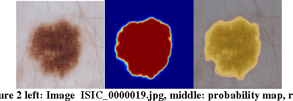 Figure 3 for ISIC 2017 - Skin Lesion Analysis Towards Melanoma Detection