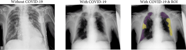 Figure 1 for Machine learning approaches for COVID-19 detection from chest X-ray imaging: A Systematic Review