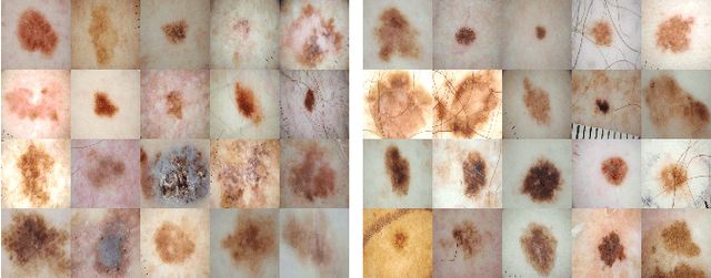 Figure 4 for Melanoma Detection using Adversarial Training and Deep Transfer Learning