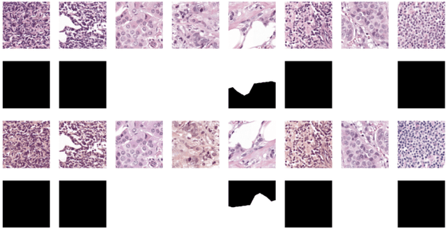 Figure 3 for Detection and Classification of Breast Cancer Metastates Based on U-Net