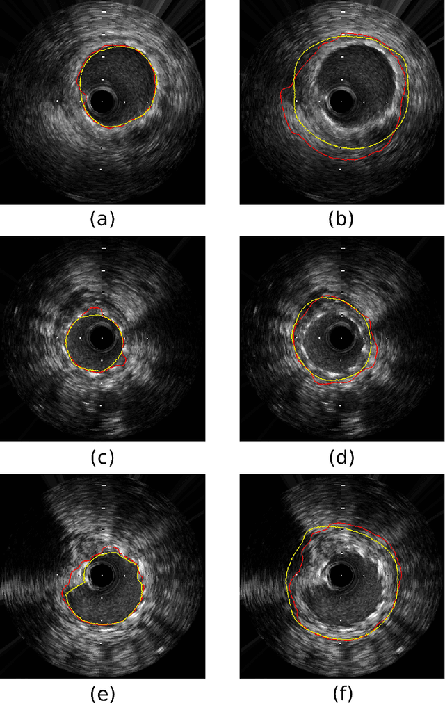 Figure 3 for Segmentation of Lumen and External Elastic Laminae in Intravascular Ultrasound Images using Ultrasonic Backscattering Physics Initialized Multiscale Random Walks