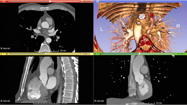 Figure 1 for Image-based immersed boundary model of the aortic root