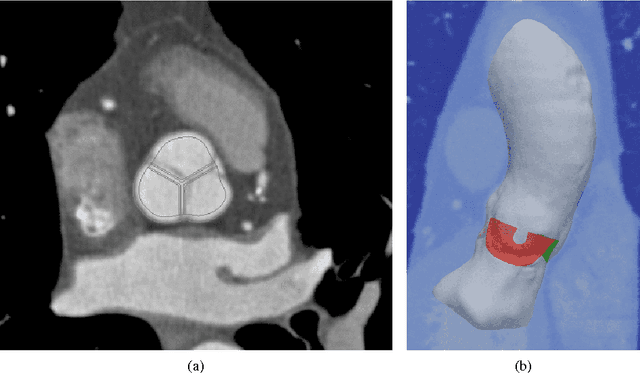 Figure 3 for Image-based immersed boundary model of the aortic root