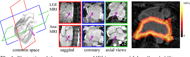 Figure 1 for Atrial fibrosis quantification based on maximum likelihood estimator of multivariate images